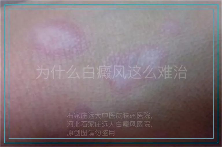 为什么白癜风这么难治