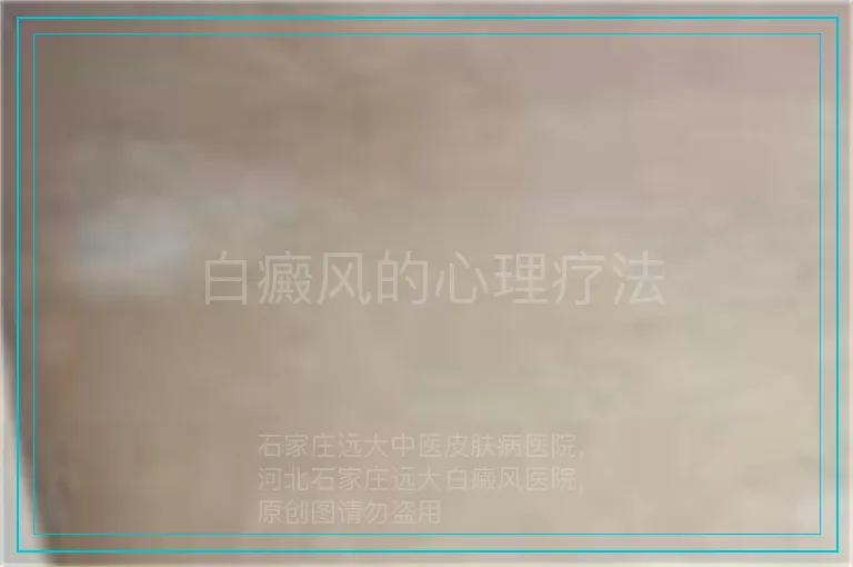 白癜风的心理疗法