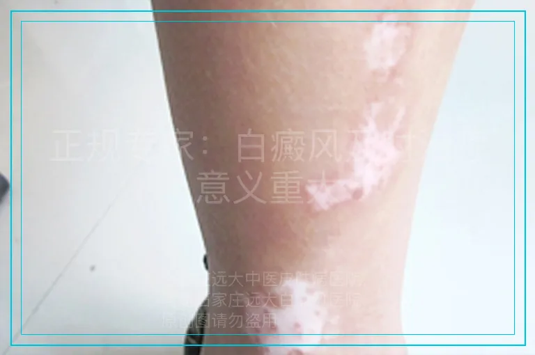 正规专家:白癜风及时治疗意义重大