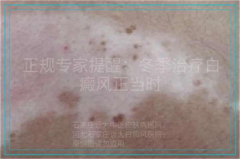 正规专家提醒:冬季治疗白癜风正当时