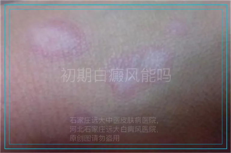 初期白癜风能吗