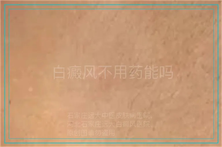 白癜风不用药能吗