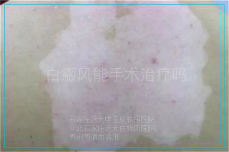 白癜风能手术治疗吗
