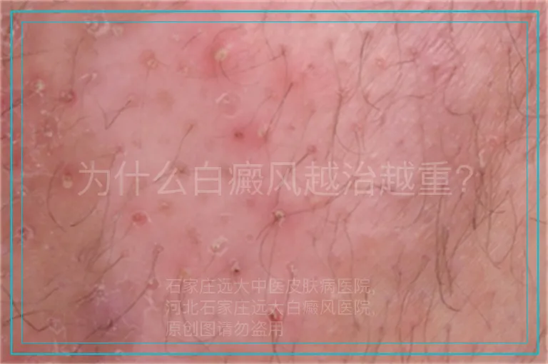 为什么白癜风越治越重?
