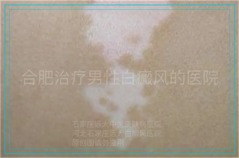 合肥治疗男性白癜风的医院