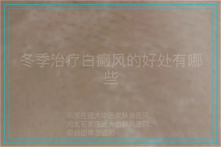 冬季治疗白癜风的好处有哪些