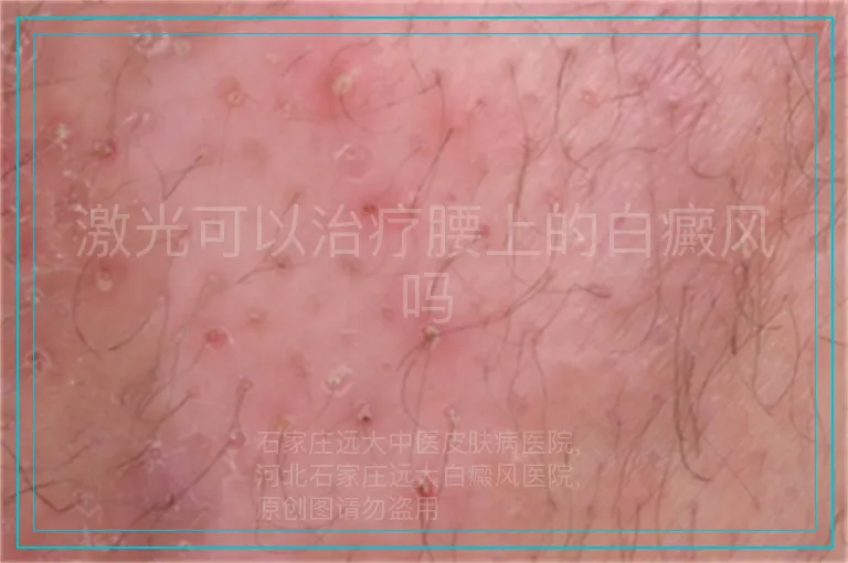 激光可以治疗腰上的白癜风吗