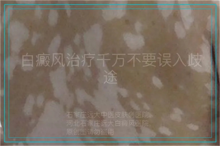 白癜风治疗千万不要误入歧途