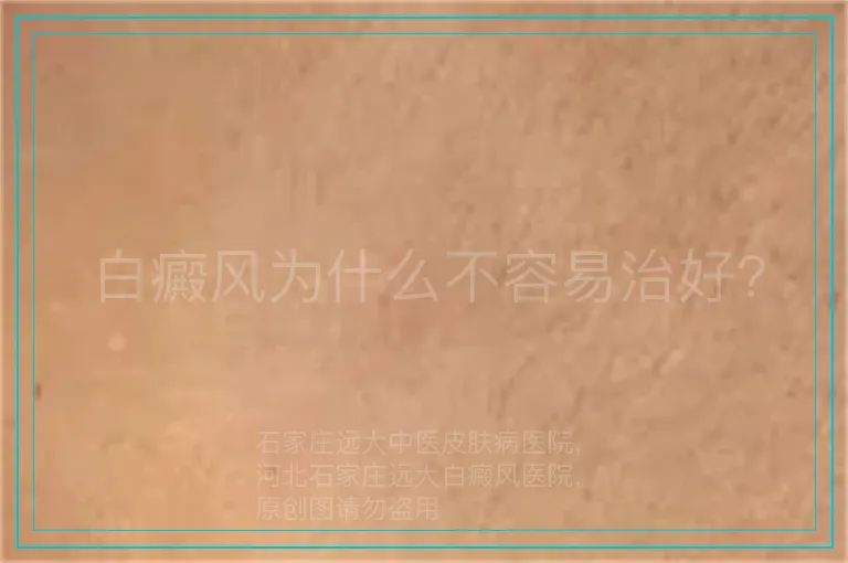 白癜风为什么不容易治好?
