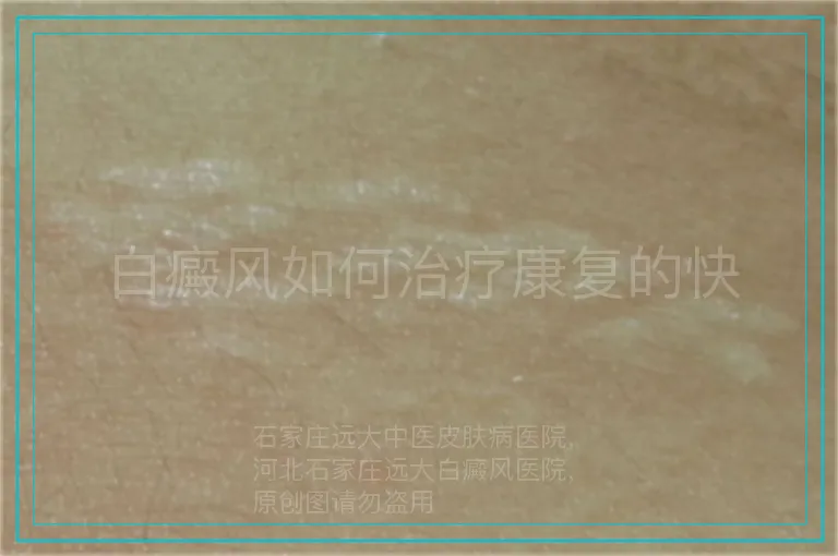 白癜风如何治疗康复的快