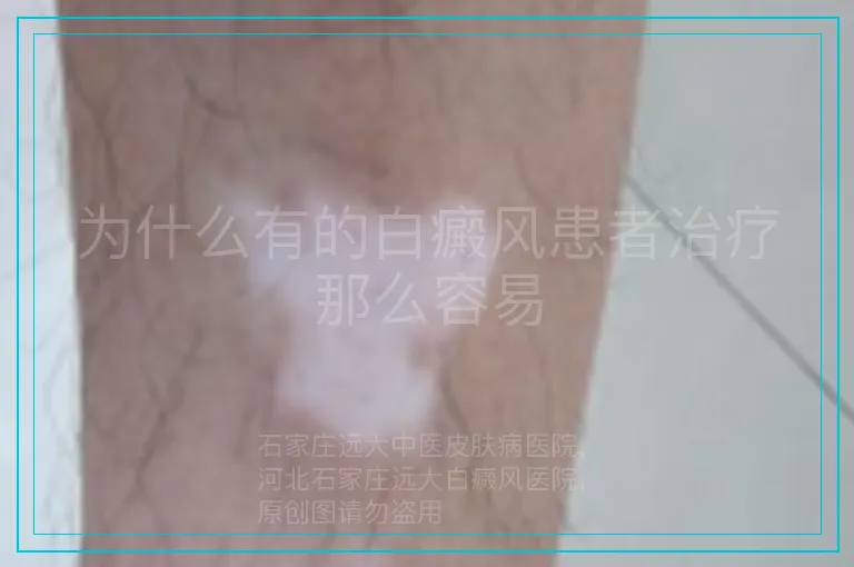为什么有的白癜风患者治疗那么容易