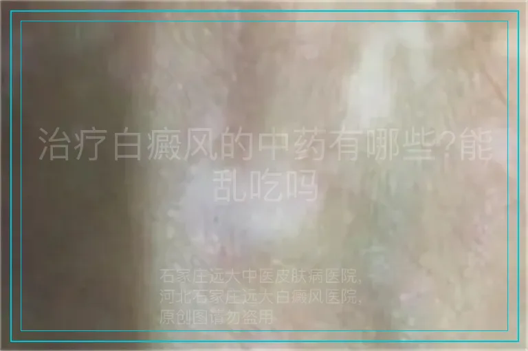 治疗白癜风的中药有哪些?能乱吃吗