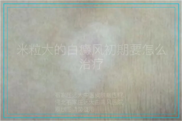 米粒大的白癜风初期要怎么治疗