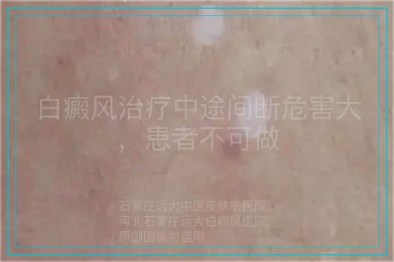 白癜风治疗中途间断危害大，患者不可做