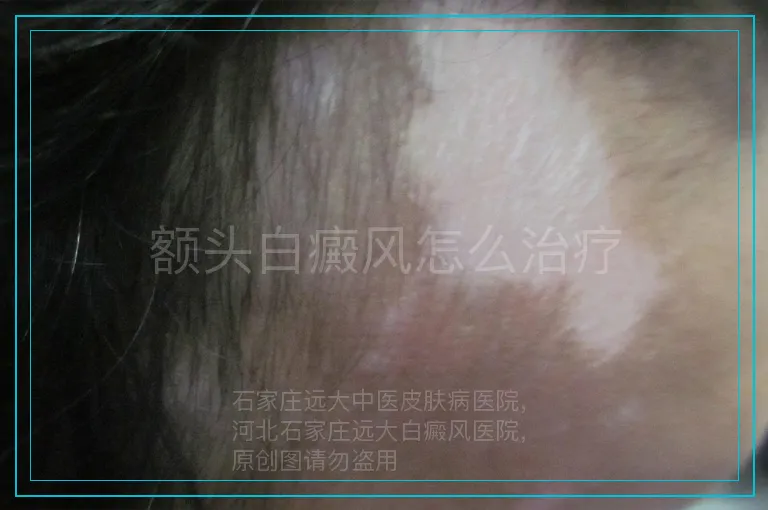 额头白癜风怎么治疗