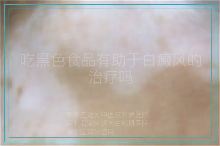 吃黑色食品有助于白癜风的治疗吗