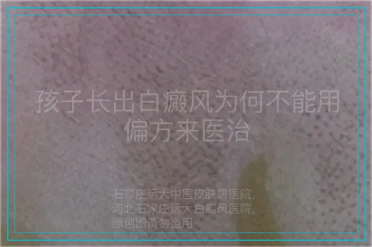 孩子长出白癜风为何不能用偏方来医治