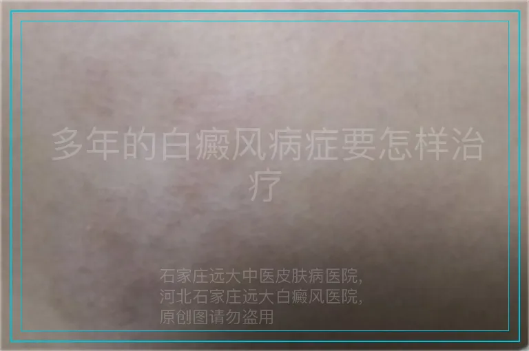 多年的白癜风病症要怎样治疗
