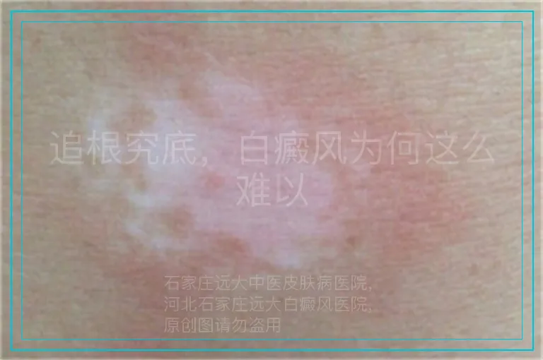 追根究底，白癜风为何这么难以