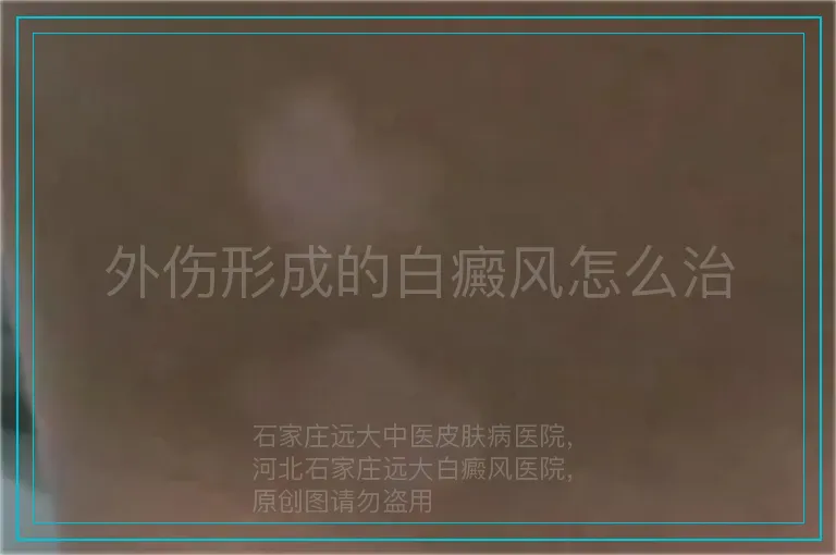 外伤形成的白癜风怎么治
