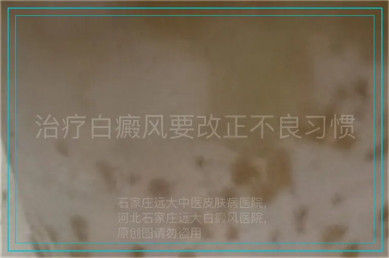 治疗白癜风要改正不良习惯