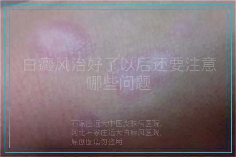 白癜风治好了以后还要注意哪些问题