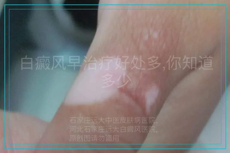 白癜风早治疗好处多,你知道多少