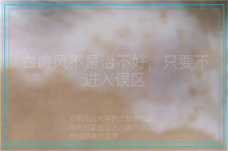 白癜风不是治不好,只要不进入误区