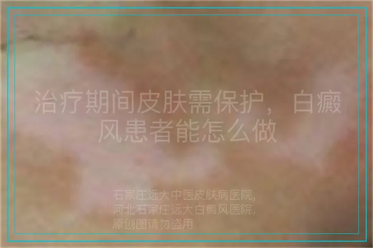 治疗期间皮肤需保护,白癜风患者能怎么做