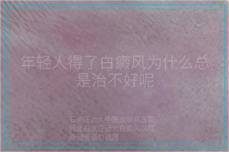 年轻人得了白癜风为什么总是治不好呢