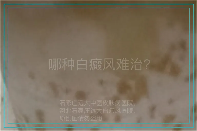 哪种白癜风难治?