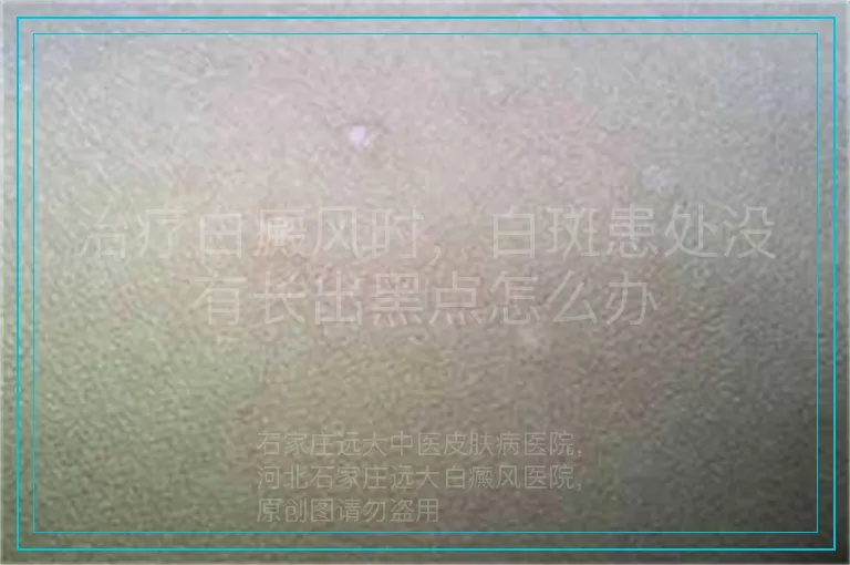 治疗白癜风时,白斑患处没有长出黑点怎么办