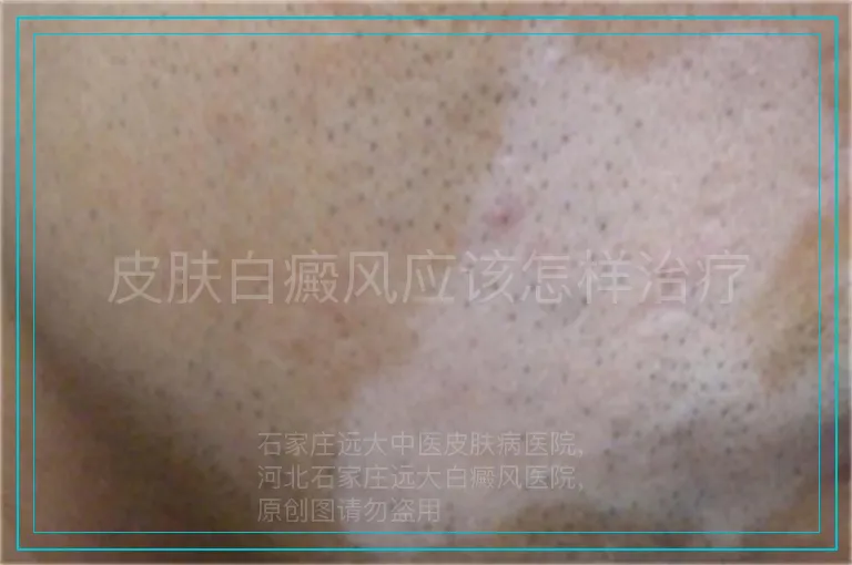 皮肤白癜风应该怎样治疗