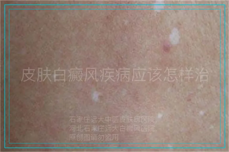 皮肤白癜风疾病应该怎样治