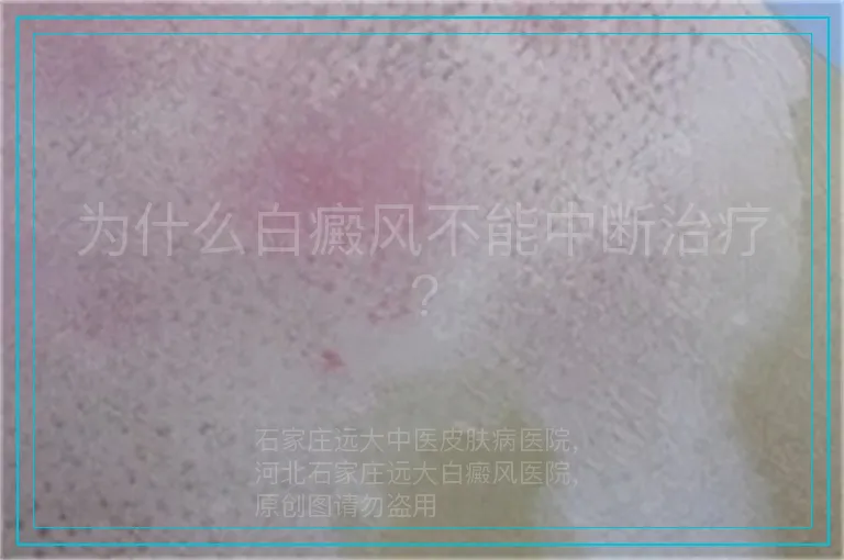 为什么白癜风不能中断治疗?