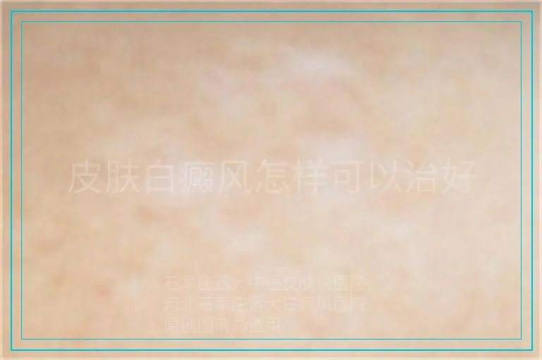 皮肤白癜风怎样可以治好