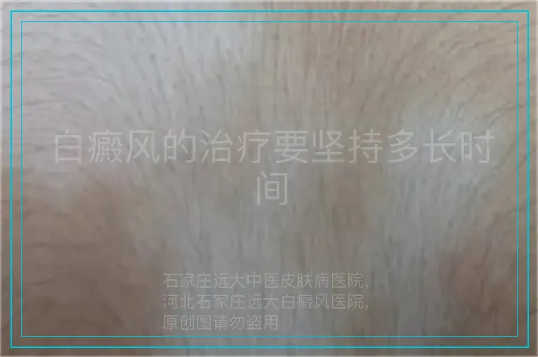 白癜风的治疗要坚持多长时间