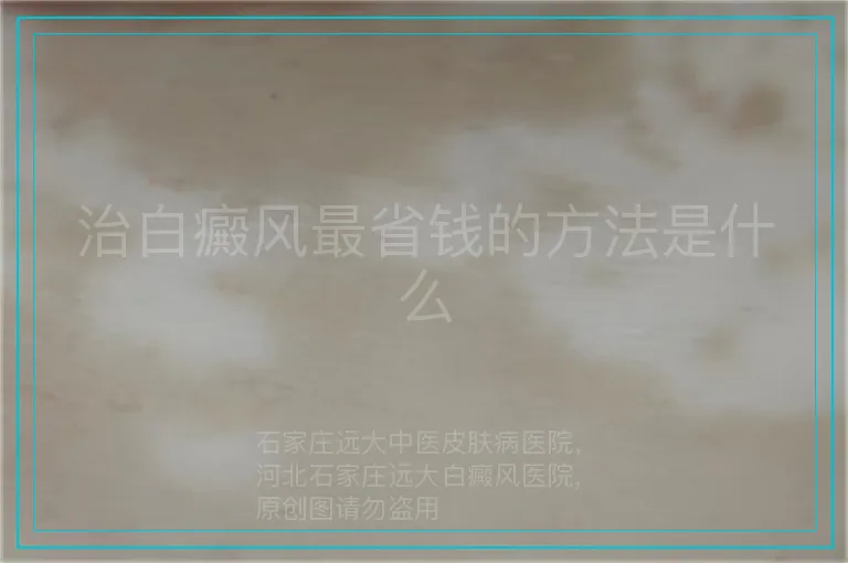 治白癜风最省钱的方法是什么