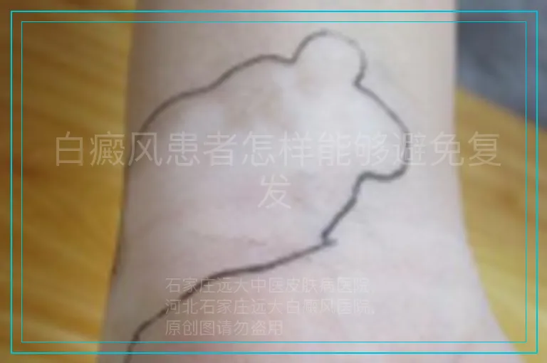 白癜风患者怎样能够避免复发