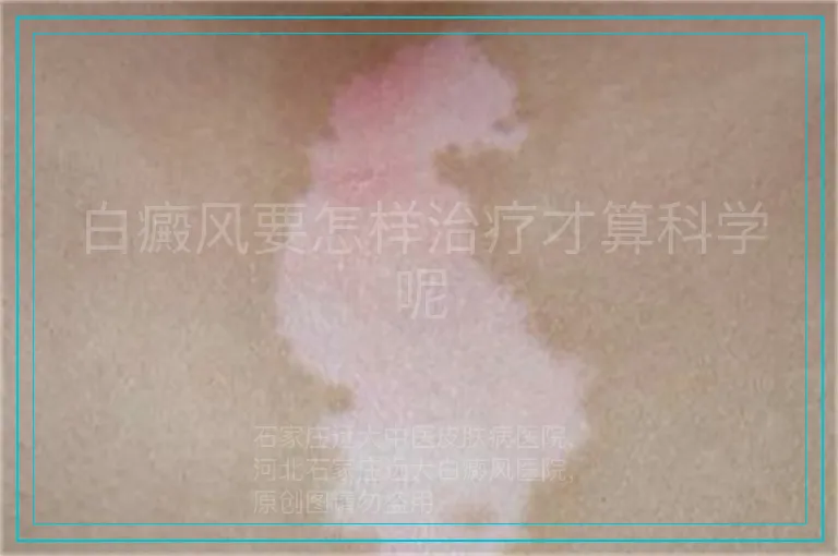 白癜风要怎样治疗才算科学呢