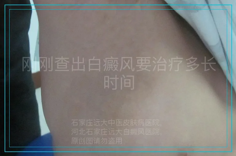 刚刚查出白癜风要治疗多长时间