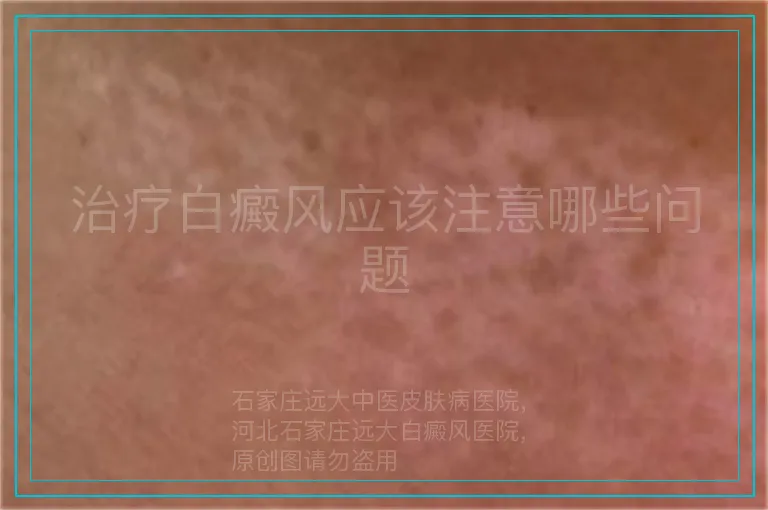 治疗白癜风应该注意哪些问题