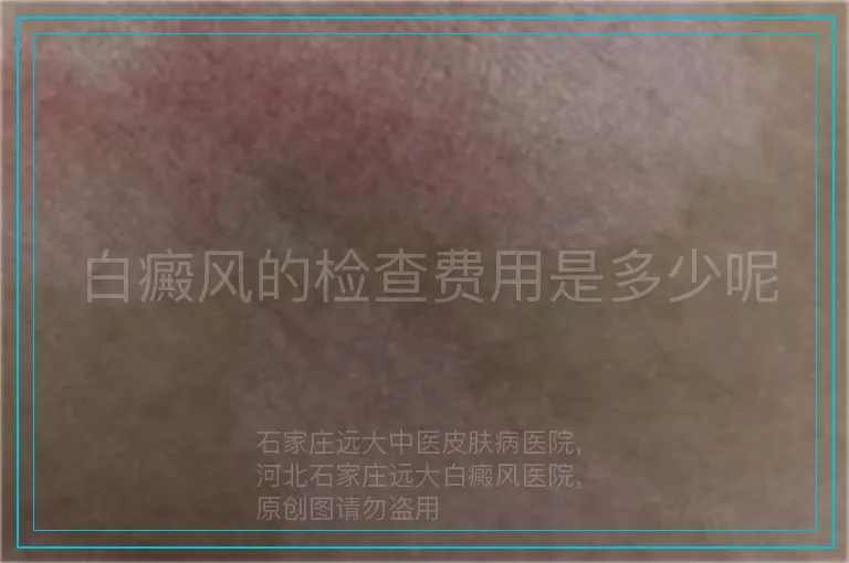白癜风的检查费用是多少呢