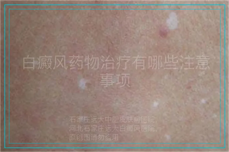 白癜风药物治疗有哪些注意事项