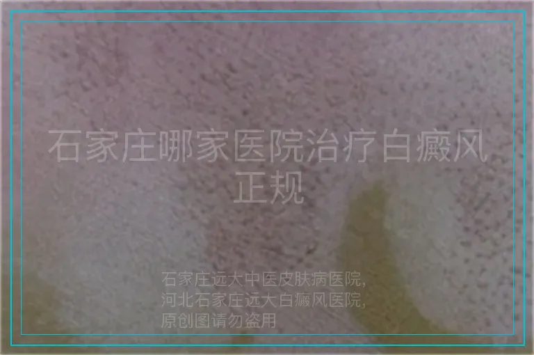 石家庄哪家医院治疗白癜风正规