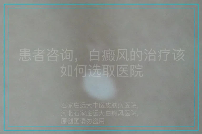 患者咨询,白癜风的治疗该如何选取医院