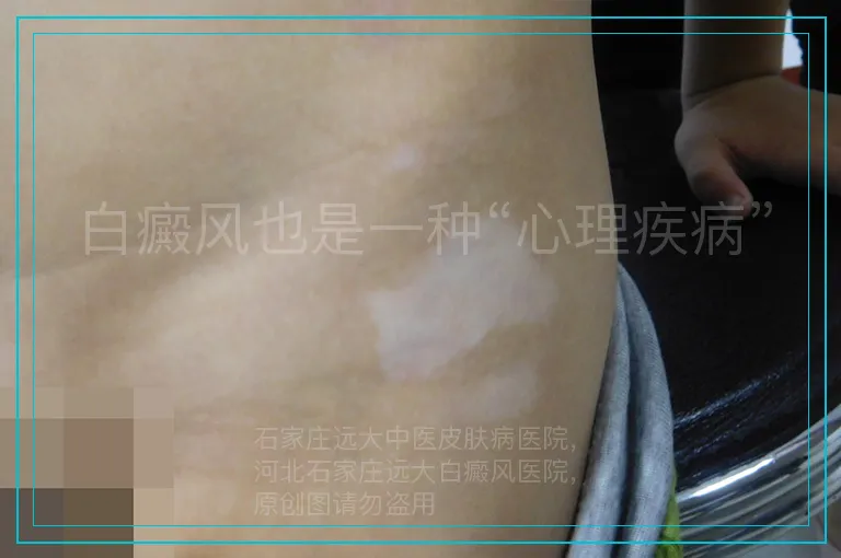 白癜风也是一种“心理疾病”
