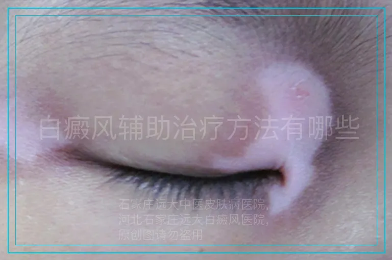 白癜风辅助治疗方法有哪些