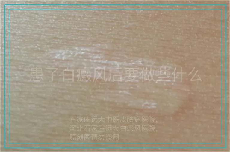 患了白癜风后要做些什么