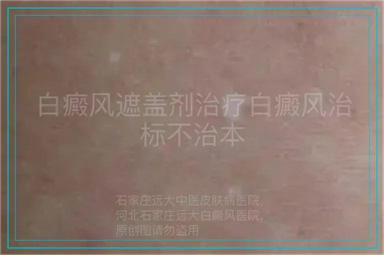 白癜风遮盖剂治疗白癜风治标不治本